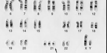 Down syndrome human karyotype 47,XY,+21 (CC BY Wessex Reg. Genetics Center)